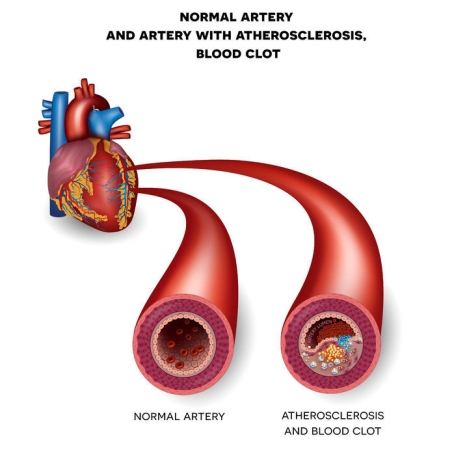 Heart Artery Blocked - Atherosclerosis